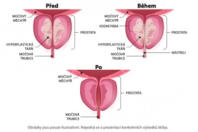 Léčba zvětšené prostaty (hyperplazie) vodní párou - Metoda Rezūm