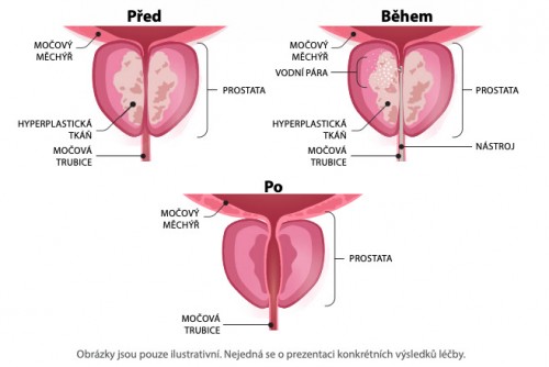 Léčba zbytnělé prostaty metodou Rezūm v UroKlinikum.