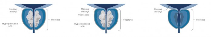 microadenoma kialakulása