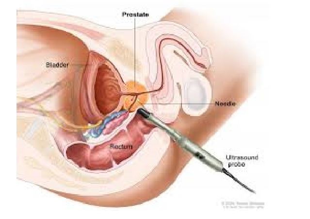 Ako dlho trva odobranie vzoriek z prostaty